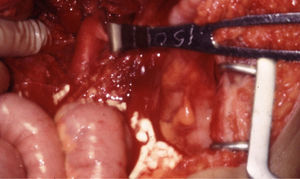 Herida por arma de fuego con afectación secundaria de la vena ilíaca común, derecha e izquierda derechas y de la arteria ilíaca derecha. Ligadura de la vena y reparación de la arteria con injerto de PTFE de 8mm.