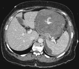 Tomografía abdominopélvica: voluminoso PQP caudal con extravasación del producto de contraste.