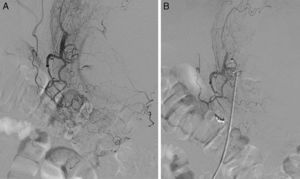 A) Arteriografía con extravasación del producto de contraste a nivel de una rama de la arteria coronaria estomáquica. B) Arteriografía tras la embolización, que confirma el cede de la fuga de contraste.