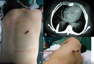 A) Herida subescapular derecha en paciente 1. B) TAC torácica en paciente 1, con extremo distal del cuerpo extraño próximo al hilio pulmonar. C) Paciente 2 empalado por una broca.
