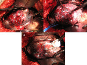 Imágenes de la intervención quirúrgica del caso 1. A) Se observa el cristal impactado en el lóbulo inferior derecho (LID) y las ligaduras alrededor de las ramas de la arteria pulmonar. B) Además de lo observado en la figura 2A, se observa vessel loop de color azul alrededor de la vena pulmonar inferior. C) Pulmón reexpandido con sutura de 3/0 en el parénquima pulmonar.