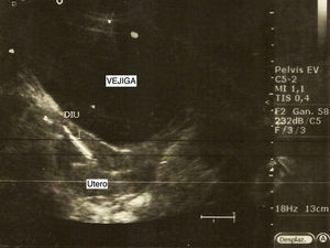 Imagen ecográfica en donde se observa el dispositivo intrauterino perforando el fondo uterino.