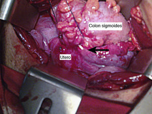 Fotografía intraoperatoria en la cual se observa el colon sigmoides adherido al fondo uterino y la salida de una rama del dispositivo intrauterino (flecha negra) por la pared del colon sigmoides.