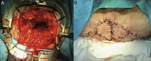A) Resultado campo quirúrgico perineal tras la extirpación amplia de todo el periné con los trayectos fistulosos. B) Reconstrucción plástica del periné con un colgajo V-Y.