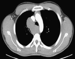 Tomografía axial computarizada torácica: masa mediastino posterosuperior que provoca desplazamiento de los vasos mediastínicos.