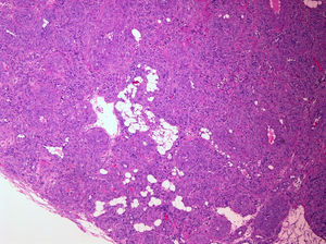 Aspecto general de la neoplasia de aspecto vascular (H&E x40).