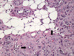 Proliferación de células fusiformes sin signos de atipia con crecimiento perivascular (flechas) y presencia de componente de tejido adiposo maduro. (H&E x200).