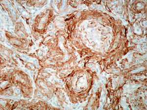 Positividad inmunohistoquímica perivascular para actina de músculo liso. (Diaminobencidina x200).