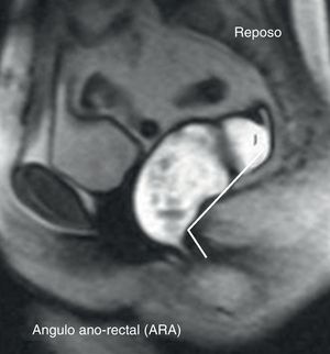 Ángulo anorrectal.Parámetro de medición sobre resonancia magnética pelviana dinámica con el paciente en reposo. Ángulo formado por un eje que pasa posterior al canal anal y el músculo puborrectal con vértice en la línea pectínea.
