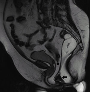 Rectocele y herniación perineal de grasa abdominal con enterocele incipiente.Resonancia magnética pelviana dinámica en defecación. Gran rectocele con nivel hidroaéreo (flecha) y hernia grasa perineal (asterisco) con enterocele incipiente.