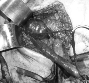 Imagen de la intervención en la que se evidencia el cordón inguinal y un quiste de cordón de gran tamaño.