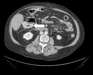 TAC abdominal: engrosamiento mural segmentario de ángulo hepático de colon.