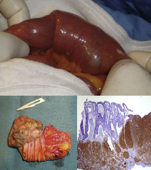 Intususcepción de intestino delgado ocasionada por metástasis transmural de melanoma maligno.