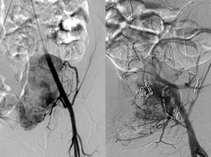 Arteriografía. Mapa vascular arterial iliaco de las ramas que irrigan la lesión (izquierda) y embolización preoperatoria de las mismas (derecha) como estrategia para reducir el sangrado operatorio.