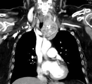 Imagen de tomografía axial computarizada donde se objetiva un gran bocio intratorácico que desplaza la tráquea, y presenta calcificaciones en su interior.