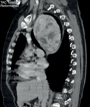 Imagen de tomografía axial computarizada donde se objetiva un gran bocio intratorácico retroesofágico.