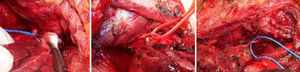 Tres imágenes que muestran la identificación alta del nervio recurrente a nivel de la articulación cricotiroidea que precede a la movilización de la porción endotorácica de sendos bocios carinales.