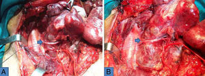 Relación compleja de la arteria tiroidea inferior (flecha), de un bocio posterior dependiente del tubérculo de Zuckerkandl y del nervio recurrente antes (A) y durante (B) la movilización de la porción endotorácica y retrovascular.