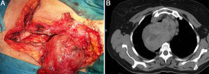 Bocio recidivado endotorácico retroesofágico que precisó un acceso combinado cervical, mediastínico y pleural derecho. A) Imagen radiológica. B) Imagen quirúrgica.