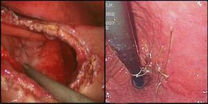 Izquierda: tras gastrotomía laparoscópica se aprecia tumoración subcardial cercana a unión gastroesofágica. Derecha: endoscopia de control tras la cirugía. Cicatriz en mucosa gástrica.