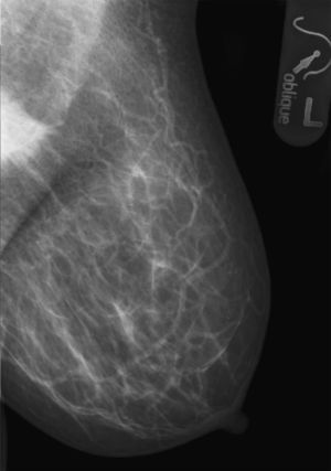 Mamografía en proyección oblicua-lateral. Se observa la tumoración de bordes espiculados altamente sugestiva de carcinoma de mama.