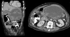 Imagen de TC correspondiente a pseudoquiste pancreático al momento del diagnóstico.