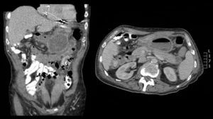 Imagen residual del pseudoquiste pancreático posterior al drenaje espontáneo a colon.