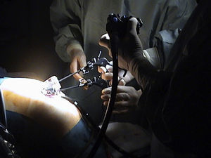 El adiestramiento con el endoscopio flexible nos puede permitir realizar maniobras quirúrgicas mediante el empleo de instrumental que accede al campo quirúrgico a través del canal de trabajo del endoscopio.