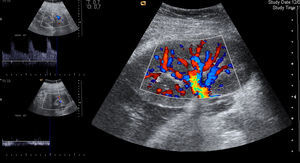 Eco doppler color y pulsado para control de los flujos del páncreas arterial (izquierda arriba) y venoso (izquierda abajo) y del riñón (derecha).