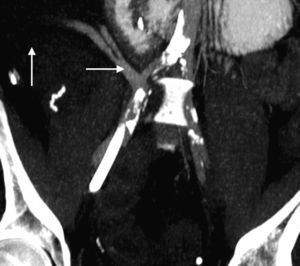 Reconstrucción vascular coronal en la que se evidencia una ausencia total de perfusión pancreática (flecha vertical). Flujo a través del injerto ilíaco en Y donante conservado (flecha horizontal).