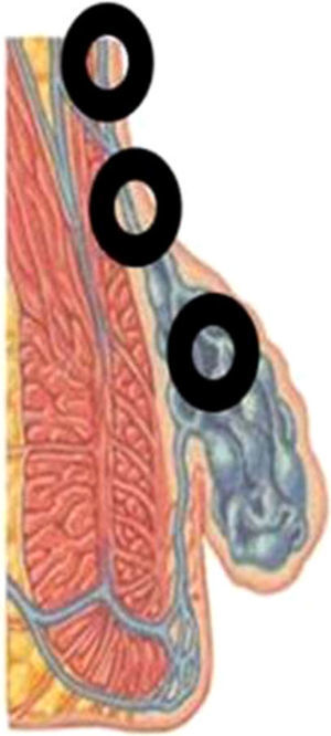 Esquema de la ligadura hemorroidal vertical.