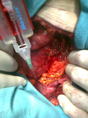 Anastomosis colorrectal.