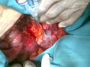 Anastomosis colorrectal tras la aplicación de tissucol.