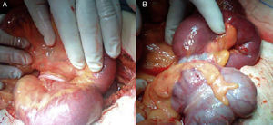 A) adherencia apendicular a mesenterio provocando un lazo apendicular. B) resecado el apéndice se aprecia anillo de constricción.