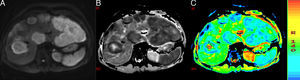 A) Imagen potenciada en difusión. B y C) Mapas de ADC. Hígado con metástasis de cáncer de colon. Se estudia una de ellas con centro necrótico, el cual se ve hipointenso en DWI e hiperintenso o rojo en los mapas de ADC con un valor de 2,34×10−3 mm2/s. La porción sólida periférica restringe la difusión, es hiperintensa en DWI e hipointensa y azul en los mapas de ADC con un valor de 1,09×10−3 mm2/s.