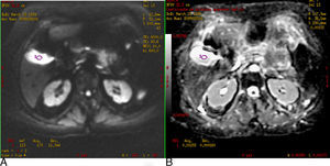 A) Imagen potenciada en difusión (b: 600 seg/mm2). B) Mapa de ADC. Efecto T2 de la vesícula biliar. En la DWI la vesícula es hiperintensa, no porque restrinja la difusión sino porque tiene un tiempo de relajación T2 largo, se comprueba con el mapa ADC donde también es hiperintensa y el valor es de 2,9×10−3 mm2/s.