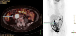 Tomografía por emisión de positrones -tomografía computarizada (PET/TC) donde se evidencia la tumoración captante en tercera porción duodenal.