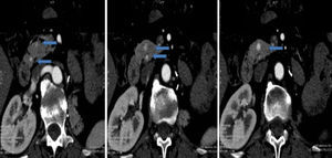 Metástasis pancreáticas múltiples.
