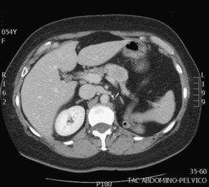 Metástasis pancreática única.