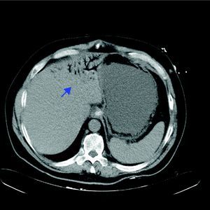 Tomografía computerizada abdominal que muestra el hematoma retroperitoneal con rotura de una tumoración a nivel de glándula suprarrenal derecha.