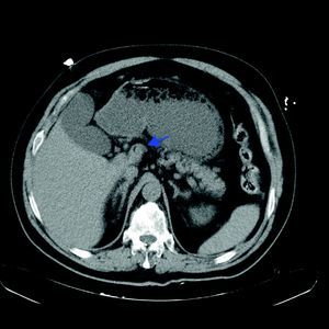 Tomografía computerizada abdominal (4 semanas después del traumatismo) que muestra la reabsorción parcial del hematoma retroperitoneal con una mejor delimitación de la tumoración.