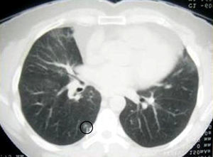 La TAC torácica muestra un nódulo pulmonar en el lóbulo inferior derecho. El arpón se halla localizado en el nódulo.