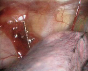 Imagen intraoperatoria toracoscópica del arpón y el parénquima pulmonar colapsado.