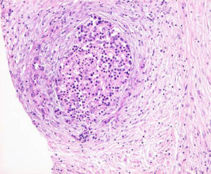 Biopsia pancreática (tinción hematoxilina-eosina, aumento 40X) –atrofia de parénquima pancreático exocrino con fibrosis (flecha) y conservación de los islotes de Langerhans.