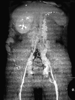 Flebotomografía que muestra retorno venoso por sistema ácigos izquierdo y cordón subcutáneo derecho.