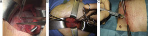 Uso de adhesivo tisular sintético en una hernioplastia anterior. A) Fijación de la malla. B) Aproximación de la aponeurosis. C) Cierre de la piel.