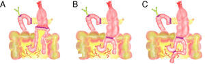 Gastroyeyunostomía antecólica A) tras antrectomía, B) tras preservación pilórica, C) con enterostomía (Braun) asociada.