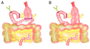 Gastroyeyunostomía retrocólica A) tras antrectomía, B) tras preservación pilórica.