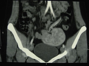 Cranealmente a la vejiga se identifica masa homogénea con vasos que penetran en la misma a través de un hilio vascular, compatible con bazo errante.