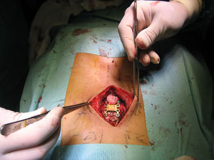 Visión intraoperatoria de placa de osteosíntesis fijando la pseudoartrosis.